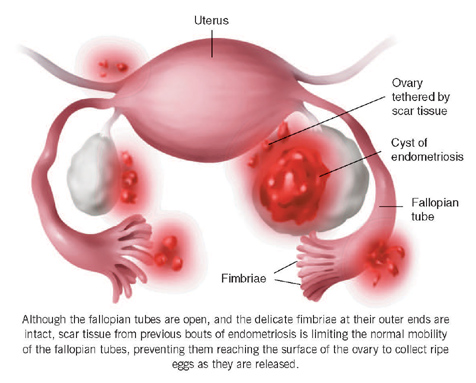 Endo What How Endometriosis Affects Fertility And How Egg Freezing Can Help