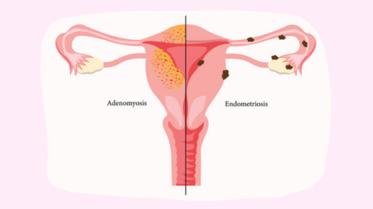 Endometriosis and Adenomyosis